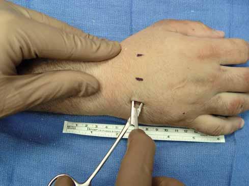 1. Surgical approach A stab incision (<5mm.