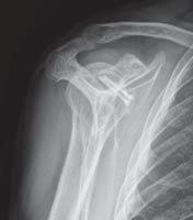 male, 32 years old Dislocated elbow