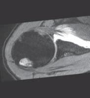 Case 8 Radial Head Fracture