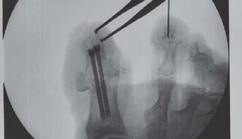 Valgus Correction Preoperative X-ray Patient: