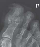 the hallux metatarsophalangeal joint with two 3.