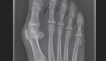 2 CCS X-ray, 6 weeks postoperative Clinical cases