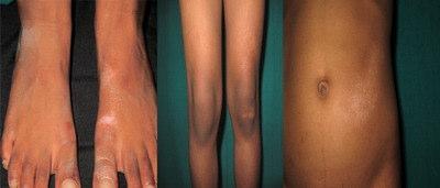 bony atrophy. Rest of her cutaneous examination was normal including genital examination. Fig 2: Close-up view of multiple atrophic, whitish patches over left foot, knee and thigh and abdomen.