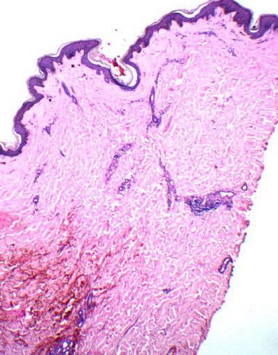 Skin biopsy specimen taken from thigh lesion, showed features consistent with lichen sclerosus et atrophicus including epidermal atrophy, vacuolar alteration of dermo-epidermal junction,