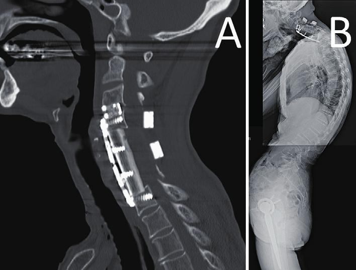 Figure 3. Images after second operation (anterior decompression and fusion from C3 to C7). (A) Sagittal reconstruction CT just after anterior fusion.