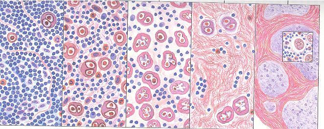 上述各亚型可以转化, 其规律是淋巴细胞为主型