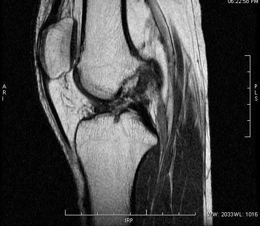 Thirty five patients with knee trauma with a clinical suspicion of internal derangement were evaluated by Magnetic Resonance Imaging during the period of two years.