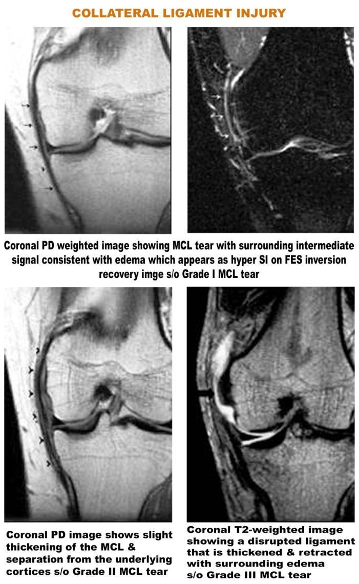 Collateral Ligament Injury: (Fig 5) In our study, medial collateral ligament tear was found in 7 cases (20%) and lateral collateral ligament tear was found in only one case (2.85%).