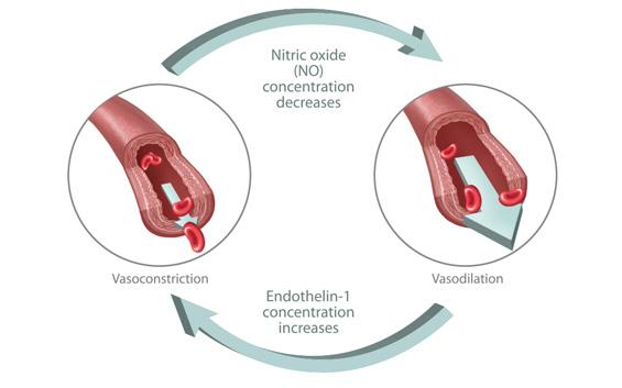 Figure 1: Hyperglycemic-induced reductions in the vasodilator nitric oxide (NO) and increases in the vasoconstrictor endothelin-1 impair dilation of blood vessels.