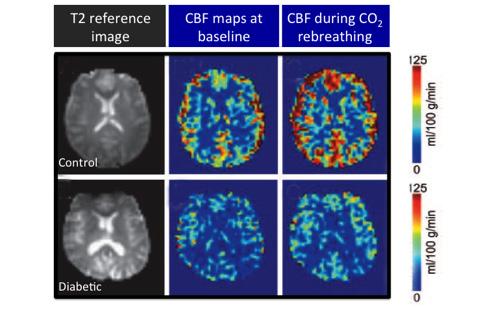Figure 2: Type 2 diabetes is associated with reduced cerebral blood flow (CBF) in resting and activated conditions (baseline versus CO 2 rebreathing, respectively).
