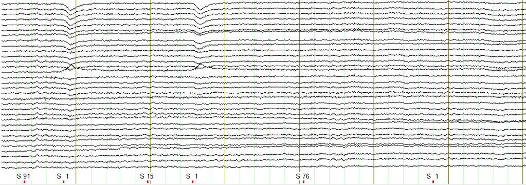 CHAPTER 1 INTRODUCTION Figure 1.7 Raw data of EEG with triggers. If the stimulus is presented, the correspondence trigger will be presented.