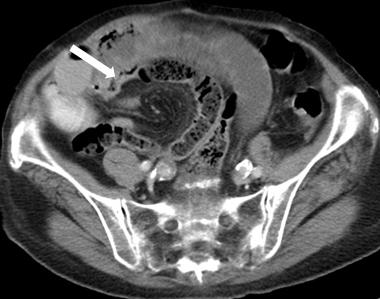 Small Bowel Obstruction After Laparoscopic Roux En - Y Gastric Bypass 175 (Reproduced from Iannuccilli J, Grand D, Murphy B et al.