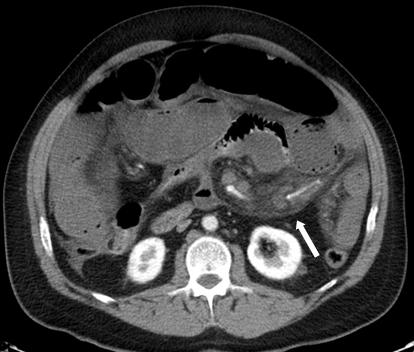 10. CT scans showing a) the Hurricane sign (arrow) and b) enlargement of lymph nodes (arrow) In a patient with history of a RYGBP who present with abdominal pain associated to abdominal bloating,