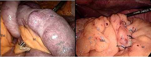 176 Advanced Laparoscopy diagnosis of hernia through the mesocolic defect.