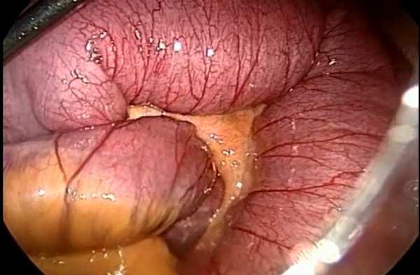 All potential sites for obstruction should be explored and all open defects must be closed even in the absence of an overt hernia.