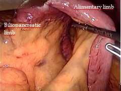 Small Bowel Obstruction After Laparoscopic Roux En - Y Gastric Bypass 171 a) b)