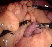 without bile content. In the Type II, the biliopancreatic limb is obstructed.