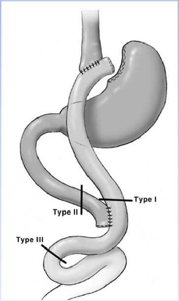 172 Advanced Laparoscopy and vomiting. Multiple air-fluid levels are seen on X-rays and there is also enlargement of the gastric remnant.