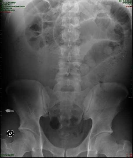 Small Bowel Obstruction After Laparoscopic Roux En - Y Gastric Bypass 173 diagnosis. In Fig 7, radiological characteristics of SBO are shown.
