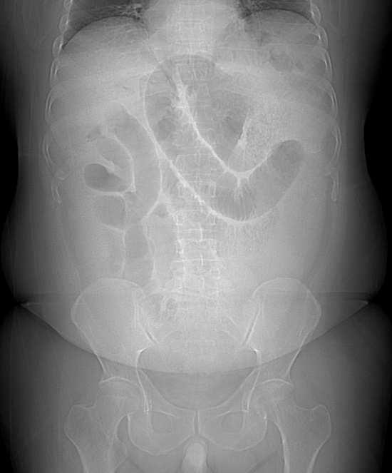 The most sensitive and specific radiologic test to confirm the diagnosis is an abdominal CT (Iannuccilli, 2009). A gastrographin upper gastrointestinal series may be used as an alternative (Fig 8).