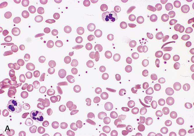 Sickle Cell Anemia Sickle cell anemia peripheral blood smear.
