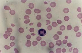 Macrocytic anemia (Folate or vitamin B12