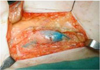 Inject into the vulvar lesion TC 99 +/ isosulfan blue dye Dissect groin in usual fashion to find the sentinel node Can find with a gamma probe or visualization of the blue dye Frozen section of the