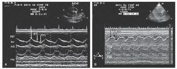 Adel Hasanin Ahmed 2 Early diastolic collapse of the right ventricular free wall in patient with pericardial tamponade.