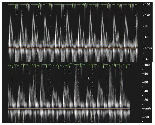 Adel Hasanin Ahmed 4 Pulsed Doppler recording of the mitral (upper panel) and tricuspid (lower panel) valve inflows in a patient with documented calcific