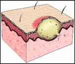 lesions such as papules to vesicles or