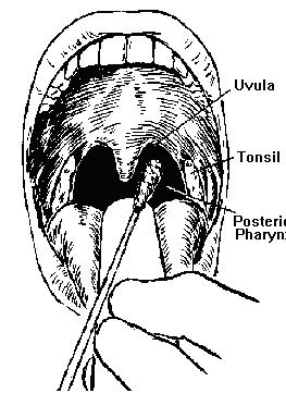 Throat swab (posterior pharyngeal swab) Hold tongue away with tongue depressor Locate areas of inflammation and exudate in posterior pharynx, tonsillar