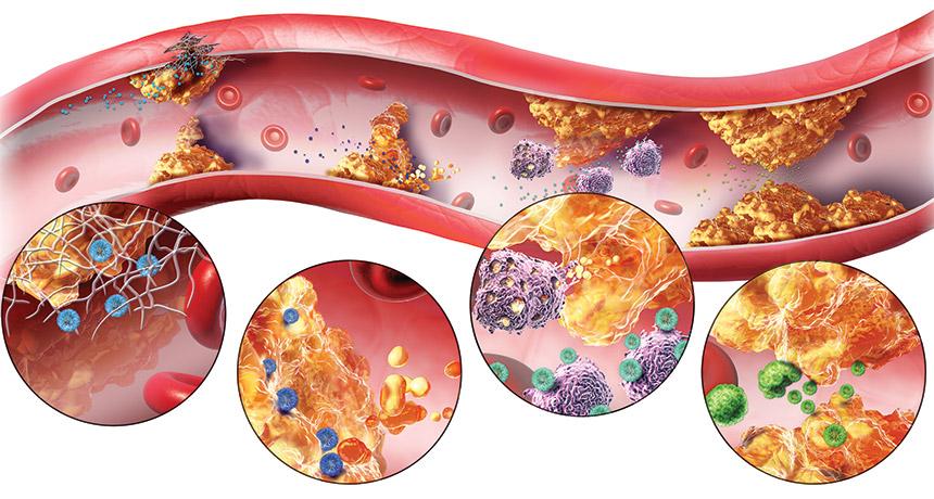 Atherosclerosis Atherosclerosis is a disease primarily of large elastic arteries and medium sized muscular arteries.