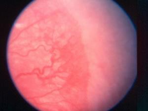 ROP Laser Treatment ROP Laser Treatment ROP LaserTreatment Risks Cataract Anterior ischemia Progression