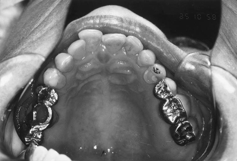 IMPLANT ANCHORAGE FIGURE 1. Preoperative occlusal view. FIGURE 2. Preoperative diagnostic casts. tooth rotations in the maxilla, and the horizontal overbite (Figs 1, 2).