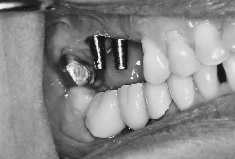 The mandibular arch was restored to an ideal occlusal relationship to coordinate with maxillary movement.