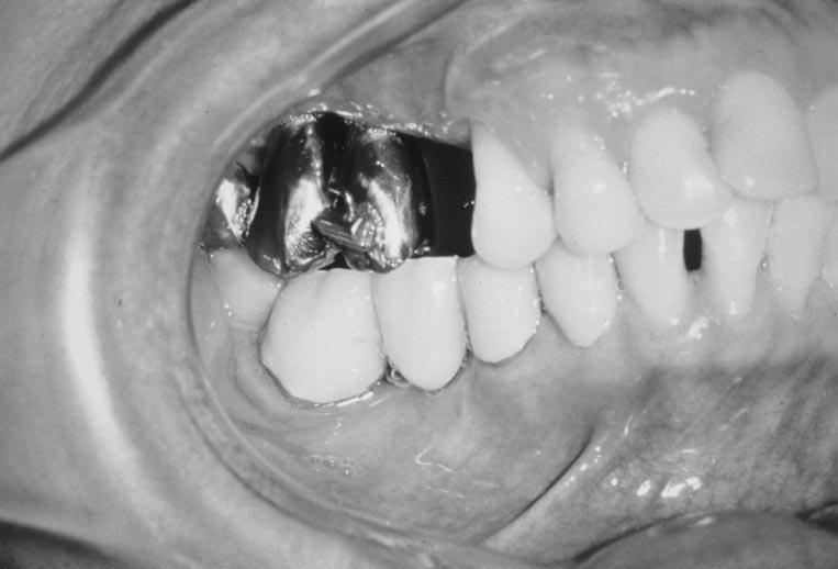 IMPLANT ANCHORAGE FIGURE 5. Splinted, temporary, nonprecious metal crowns with orthodontic bracket. FIGURE 6. Final orthodontic result utilizing both implants as anchorage.