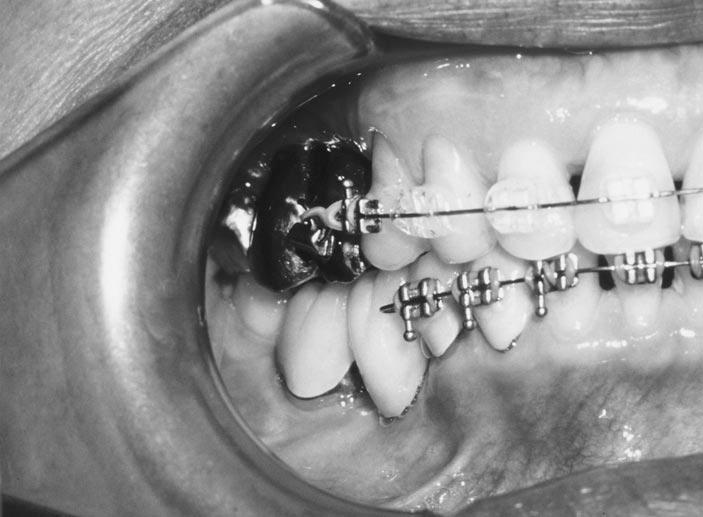 Two Seri-Oss threaded, hydroxyapatitecoated screws (Steri-Oss, Inc, Yorba Linda, CA) were placed in teeth 2 and 8 Journal of Oral Implantology 3 areas utilizing the surgical template.