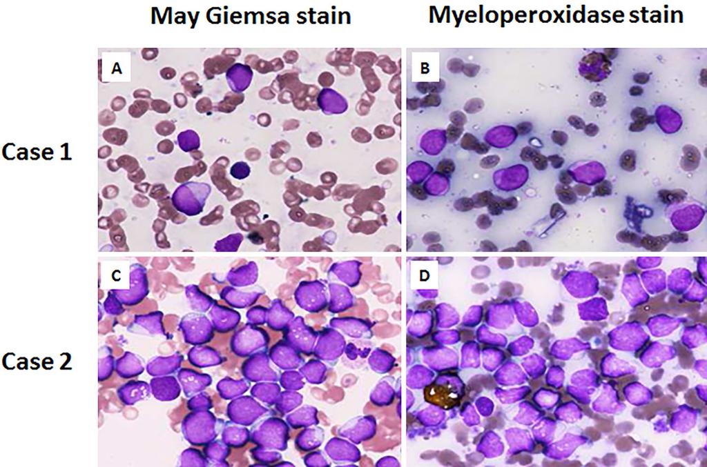 Figure 1. Blast cells in bone marrow. Blasts within a dimorphic population are shown. Myeloperoxidase stain is negative. (A, C) May Giemsa stain, 1,000. (B, D) Myeloperoxidase stain, 1,000. Figure 2.