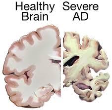 Clinical application of NTF Alzheimer s disease (AD) and