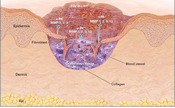 Wound healing Promote wound healing Granulation ( 肉芽生成 growth of connective tissue ( 结缔组织 ) and small blood vessels at