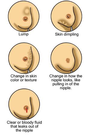 Picture below shows signs of breast cancer or what to look for. SCREENING FOR BREAST CANCER Screening and early detection is key to good outcome for breast cancer treatment.