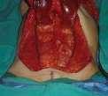 TRAM Flap A football-shaped section of skin, fat, blood vessels, and muscle is taken