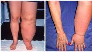 LYMPHEDEMA Is swelling that occurs from damage to the lymph vessels caused by the removal of lymph nodes or radiation to the area Removal of the nodes and