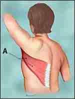 Lat Flap The muscle is used to form a breast mound, or more commonly, a pocket where an implant is placed.
