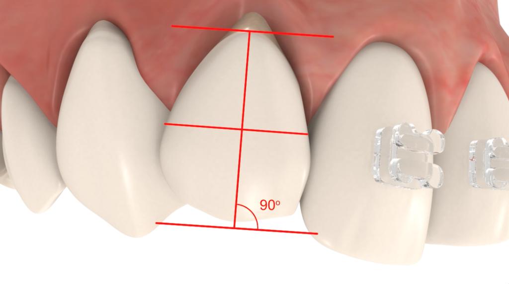 In the above case, as is very common with adult teeth, there has been incisal edge wear which will most likely be corrected after the alignment stage with composite bonding.
