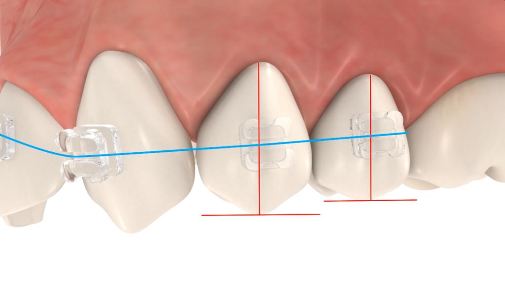 the arch wire slot parallel to the incisal edge before any wear had taken place.