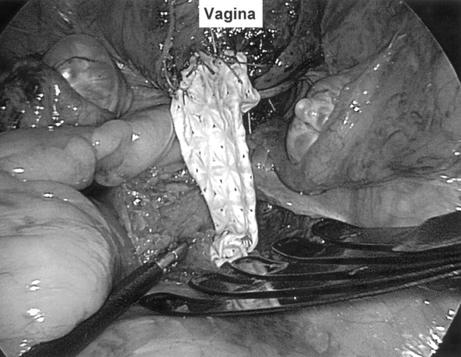 The peritoneal surface is dissected off the vaginal apex while simultaneously mobilizing the bladder anteriorly and the rectum posteriorly.