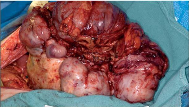 Improved tumor perfusion and increased growth fraction Large, bulky tumors have poor vascularity which exposes to suboptimal chemo Large