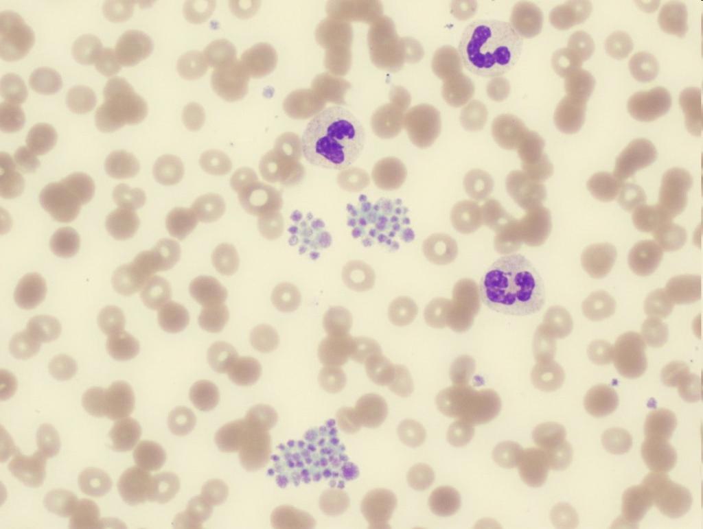 Pseudothrombocytopenia Platelet clumping seen with