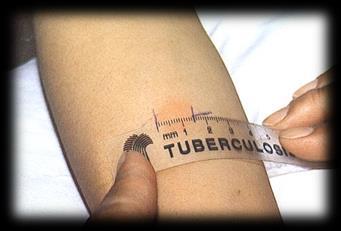 The Current Screening Test fr TB Tuberculin Skin Test ( TST ) This methd has
